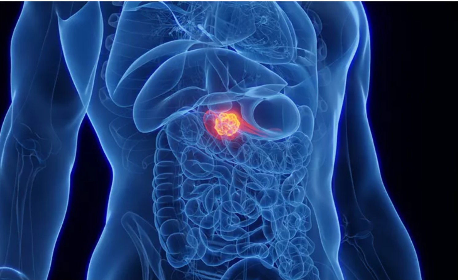 Can mRNA vaccines stop pancreatic cancer from spreading? Early trial suggests so